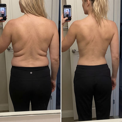 HISKIN® BREAST ENHANCEMENT  LIFT & FIRM MICRONEEDLE PATCHES